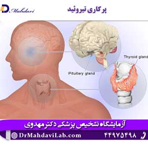 پرکاری-تیروئید