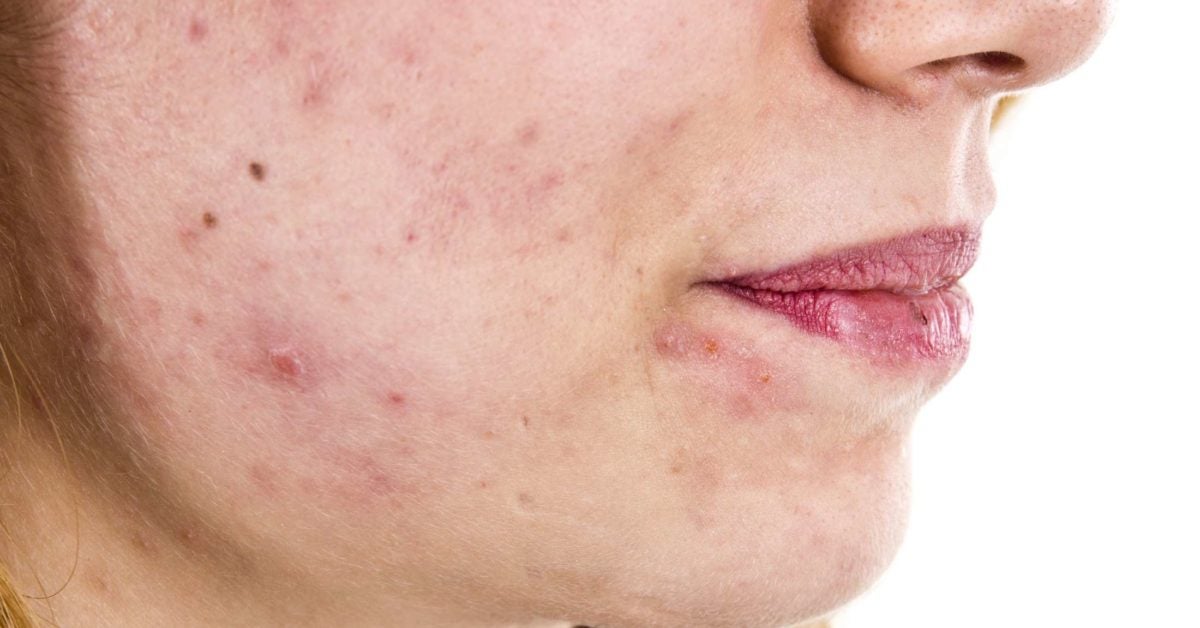 چه چیزی باعث افزایش هورمون مردانه در زنان میشود