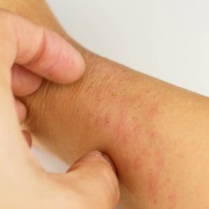 علائم ایدز بعد از چند سال نمایان میشود