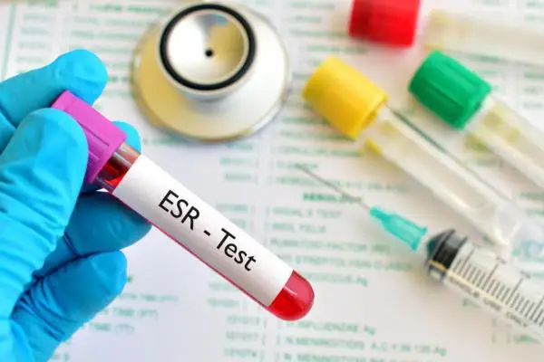 مقدار نرمال esr در زنان چقدر است