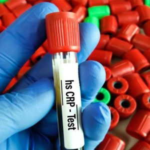 تفسیر آزمایش خون crp