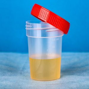 فرق کشت ادرار با آزمایش ادرار