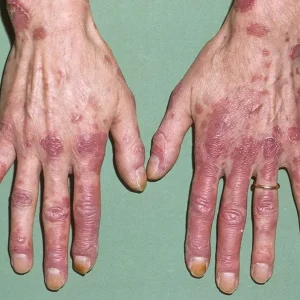 پرسش و پاسخ بیماری لوپوس