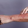 علائم ایدز بعد از یکسال