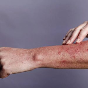علائم ایدز بعد از یکسال